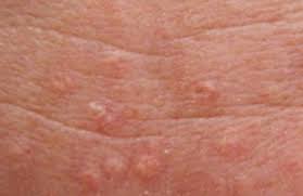 Image result for Sebaceous Hyperplasia