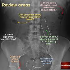 Read On For Some Tips That Helped Me With Axr Interpretation This Is Something I Found Cha Radiology Student Diagnostic Imaging Medical Knowledge