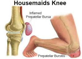 Consultant orthopaedic & sports surgeon, mr sudhir rao, explains the different causes of knee pain. Housemaids Knee Symptoms Diagnosis Treatment