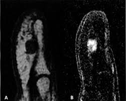 Image result for Glomus tumor
