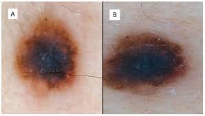 Image result for Spitz Nevus