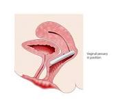 Image result for what is the treatment for a prolapsed bladder