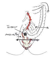 Fausses idées sur la coloscopie. Colon Apres La Chirurgie Centre Lyonnais De Chirurgie Digestive