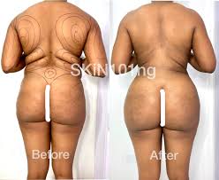 That's why it's so essential to avoid putting a strain on the area. Butt Lift Via Fat Transfer To Buttocks Skin101 Center