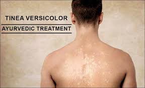 This is then followed, days to weeks later, by a rash of many similar but smaller round or oval lesions, mainly on the trunk and upper limbs. Tinea Versicolor Treatment In Ayurveda Fastest Way To Cure
