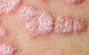 Disse er hvite flekker på huden av et ovalt barn,liten størrelse, hovedsakelig på ansiktet, finnes også på hender og kropp (øvre del). Psoriasis Altomhelse No Kunnskap Trygghet Nysgjerrighet Gjennom Hele Livet