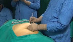 Palmer is an amazing cosmetic surgeon. Laparoscopic Palmer S Access Technique