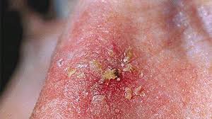 Skin Lesions Pictures Causes Types Risks Diagnosis And