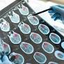 New Alzheimer's Drugs Critically Evaluated: Limited Cognitive Benefits Despite Amyloid Reduction