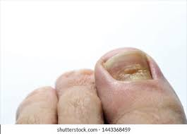 Image result for Beau lines feet