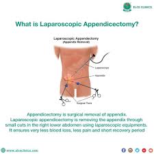 What Is Laparoscopic Appendicectomy Appendix Laparoscopy Surgery Awareness Teamelce Best Hospitals Daily Health Tips Laparoscopic Surgery