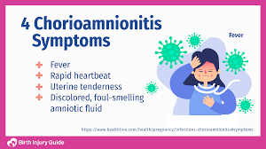 Image result for Chorioamnionitis