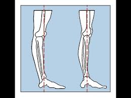 The hyperextended knee gait is marked by various degrees of abnormality. One Minute Anatomy Hyperextension Of The Knees Youtube