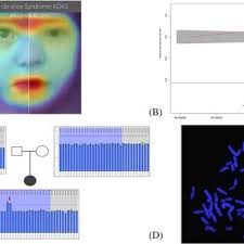 Family 2. A: Family pedigree revealing thumb anomalies in multiple...