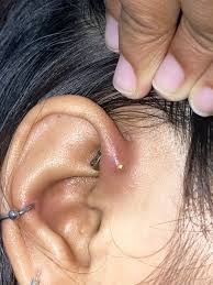 How To Treat Infected Ear Piercings, From Dermatologist