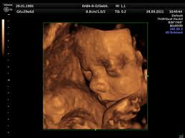 Wohl kaum etwas schürt die vorfreude auf ein baby mehr, als via ultraschall einen ersten blick auf das kleine würmchen erhaschen zu können. 3d 4d Ultraschall Dr Med Leoni Hafner