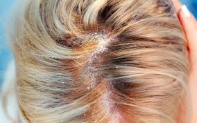 Il ph neutro dellacqua impedisce anche infezioni del cuoio capelluto. Ogni Quanto Lavare I Capelli