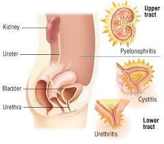 The paper presents the results of a study of the female urethra in cases of urethral pain syndrome (ups) and inflammatory diseases of the lower urinary tract using. Urinary Tract Infection In Women Causes Symptoms Treatment Options Drugs Com