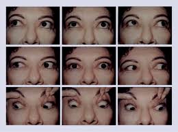 Full article: Thyroid orbitopathy