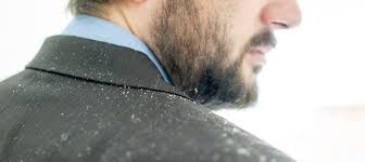 Here are five most common hair problems and solutions. How To Prevent Dandruff In Men The Urban Guide