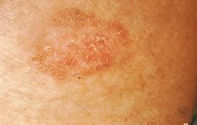 In the united states, it's estimated that doctors diagnose over 100,000 new skin cancer cases each year. Skin Cancer Parknorthdermatology