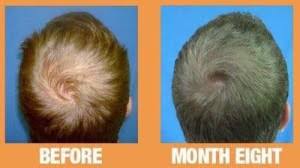 Typical hair loss services involve a combination of laser treatment plus topical hair regrowth solution, special shampoos and conditioners, medication and/or herbal supplements. Hair Loss Treatments In Lahore Pakistan Injection Therapy Cost
