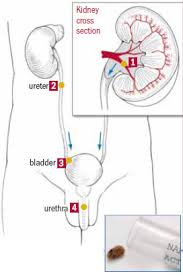 How To Prevent Kidney Stones Harvard Health