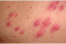 Also, make sure to hold your skin taut before epilation because when your skin is loose, it not only cause pain but also results in ingrown hairs. Ingrown Hair How To Prevent Ingrown Hairs After Epilation