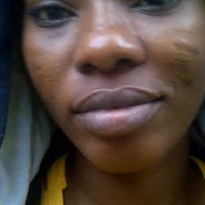 I have a bold tribal mark given to me when I was a child, what are my  options to get rid of it? (Photos)