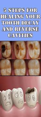 Picture of bateman dentistry staff. 42 Natural Cavity Fix Ideas Cavities The Cure Heal Cavities
