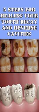 You can also focus on eating foods that help fight decay, such as dairy products and raw vegetables. 42 Natural Cavity Fix Ideas Cavities The Cure Heal Cavities