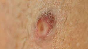 Inner thigh bumps may appear because of blocking follicles by ingrown hairs and get inflamed and filled with pus. How To Get Rid Of Boils On Inner Thigh Youtube
