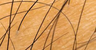 Surgical tweezer for ingrown hair. Ingrown Hair Cyst Treatments Causes And Prevention