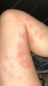 Image result for erythema nodosum