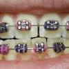 Retainers are an important step in any orthodontic treatment because they are responsible for holding your teeth in their correct if you have any doubts as to which option is best for you or want professional advice on your case regarding aligners and retainers, you can. 1