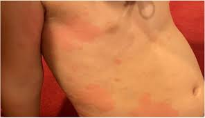 Image result for Urticaria pigmentosa children