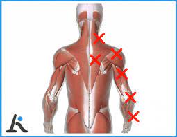 Cervicobrachialgia 5 Sintomi E 3 Esercizi Efficaci L Altra Riabilitazione