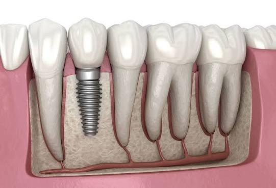 Dental care related to Dental Implants