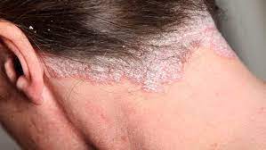 O próprio sistema de defesa do corpo começa a atacar as células dermatológicas por algum motivo, causando lesões. Psoriase Entrevista Drauzio Varella Drauzio Varella