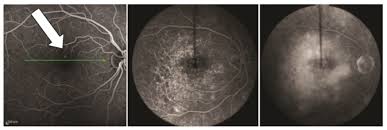 Retina Altinda Sivi Birikmesi Retina Odemi Nedir Neden Olur
