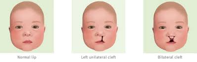 A visible scar will be left after cleft lip repair surgery and it may appear red, swollen and bruised after surgery, but this will fade considerably as it heals and your child gets older. Cleft Lip Fact Sheet Children S Health Queensland