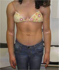 It is inherited in an autosomal recessive fashion and is observed in the highest frequency with parental consanguinity. Berardinelli Seip Syndrome Highlight Of Treatment Challenge Bmj Case Reports