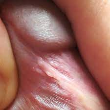 Tyson Glands Or Warts? Conflicting Diagnosis! (Pics) | Penis Disorders |  Forums | Patient