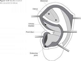 Ear Acupuncture Morning Sickness My Fertility Guide