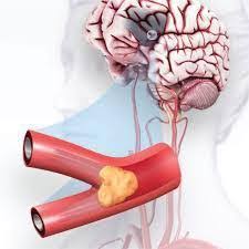 Mengecilkan liang roma campur kan satu sudu jus tomato segar 17. Benarkah Tomat Dan Bawang Putih Untuk Mengobati Stroke Brainly Co Id