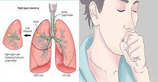 (in other words, you didn't so although shortness of breath is one of the classic symptoms of lung cancer, it tends to go unnoticed among many people until it's quite pronounced. 11 Warning Signs Of Lung Cancer Top Viral Articles