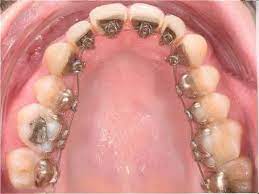 Kleinere korrekturen beginnen bei etwa 500 euro, eine festsitzende spange beginnt bei 1.500 euro und bei einem kiefergelenkdefekt geht es bei 6.000 euro los. Zahnspange Fur Erwachsene Behandlung Kosten Vorher Nacher Video