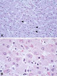 Maybe you would like to learn more about one of these? Histopathologic And Ultrastructural Features In Livers Of Ebola Ebo Download Scientific Diagram