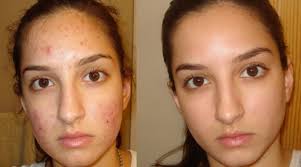 Pin On Remove Acne Scars