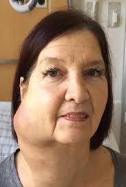 Richter-Transformation: Zelluläre Therapien